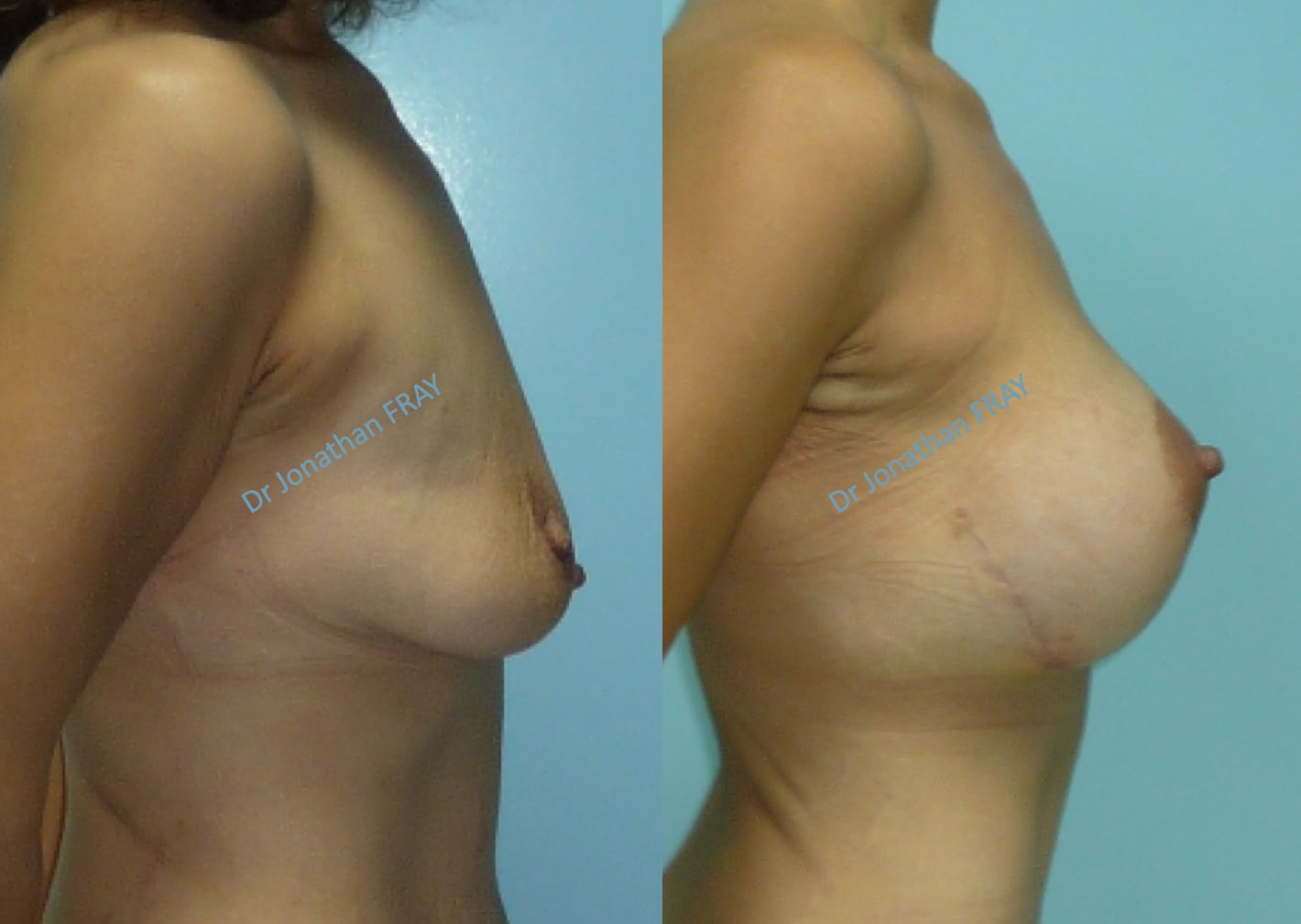remonte-seins-avant-apres-1 Remontée des seins avant après