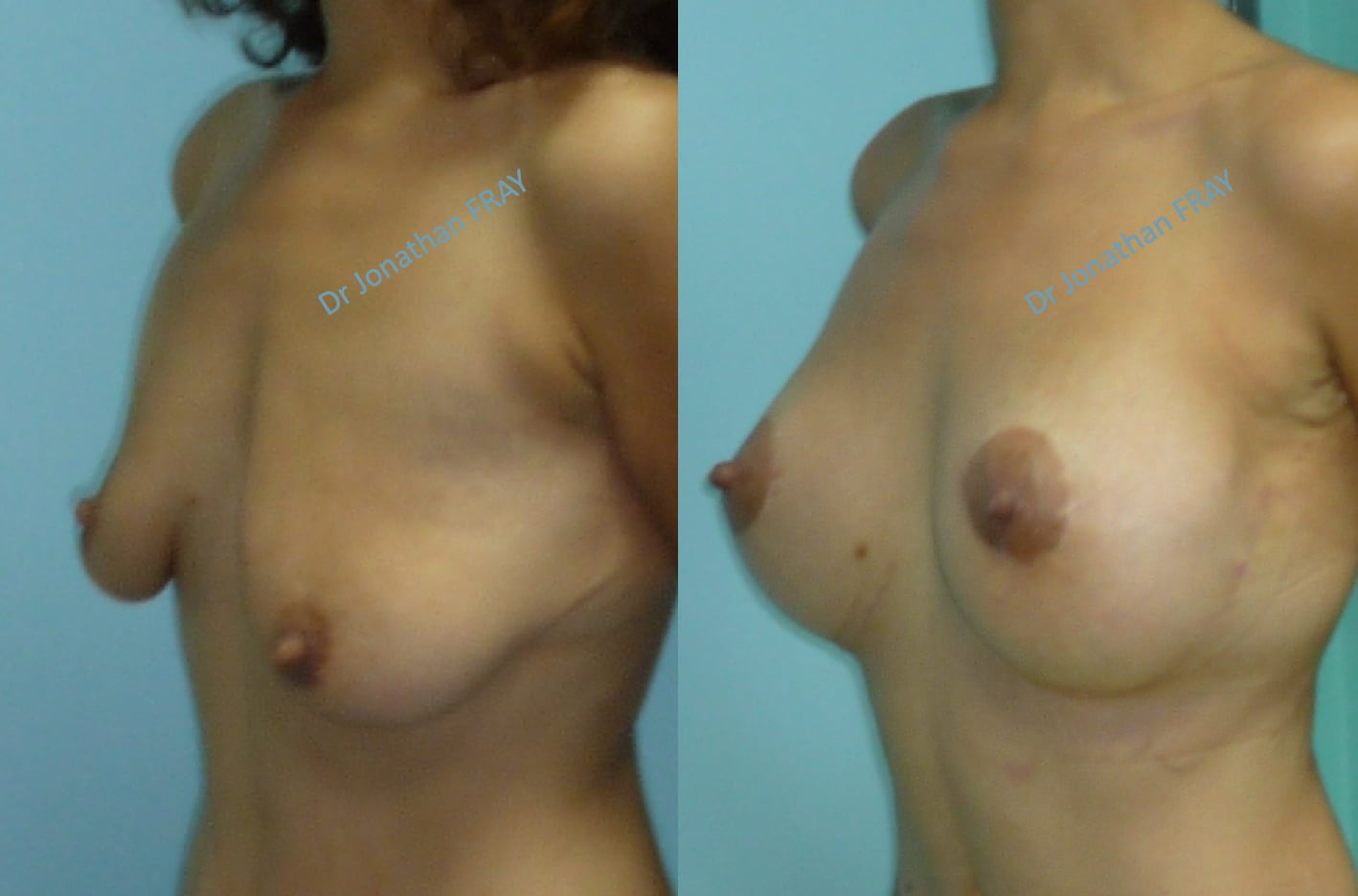 remonte-seins-avant-apres-4 Remontée des seins avant après