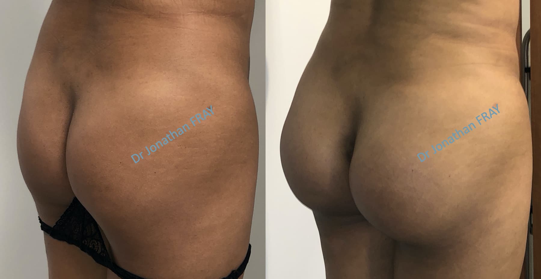 prothese-fesse-1 Photos avant après de prothèse de fesses à La Réunion