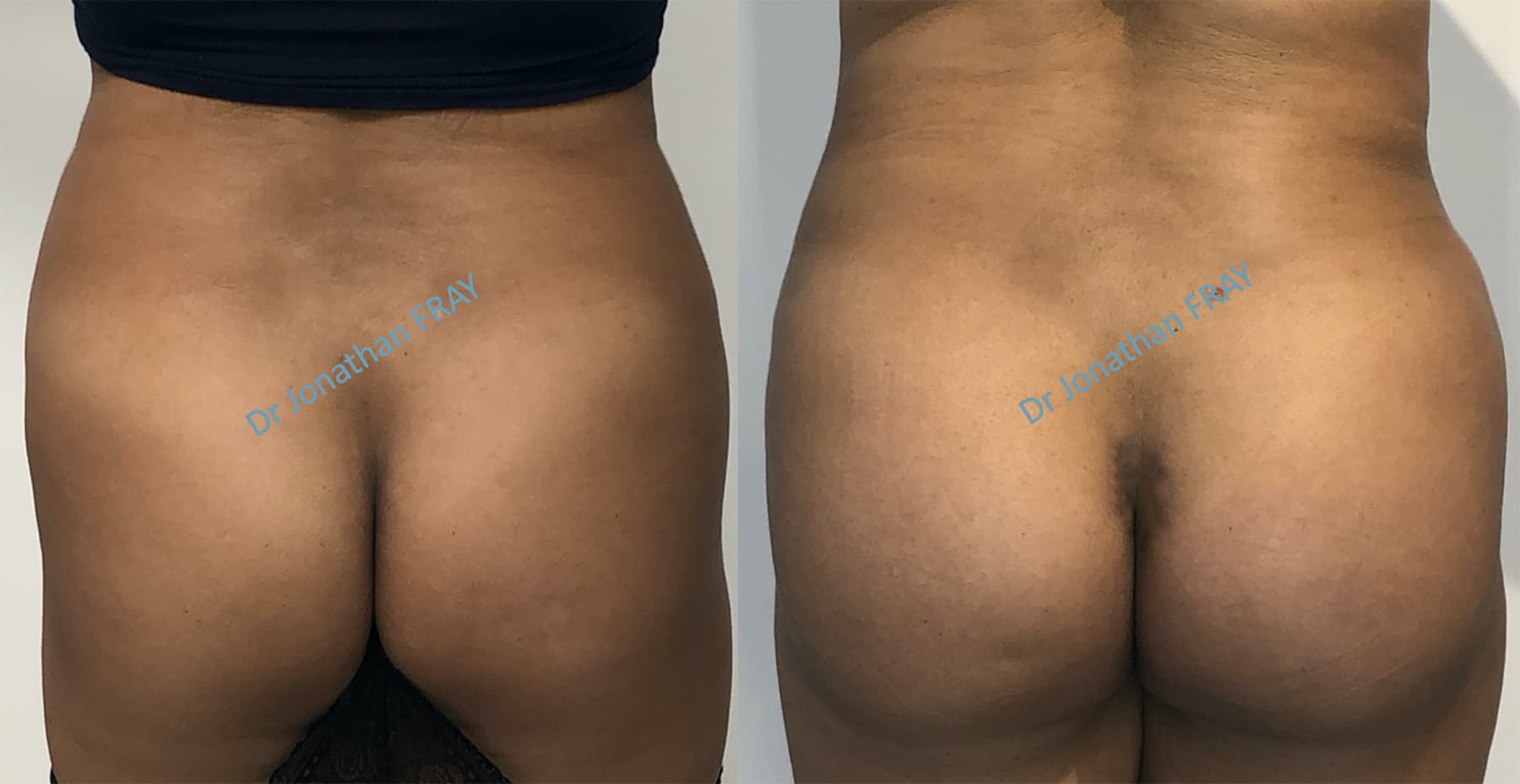 prothese-fesse-2 Résultat avant après d'une pose de prothèse de fesses à la Réunion