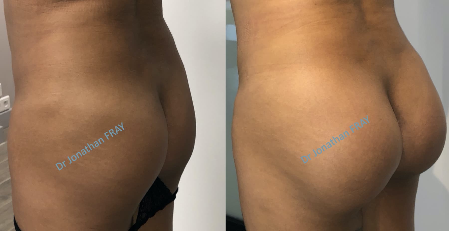 prothese-fesse-3 Avant après d'implant fessier