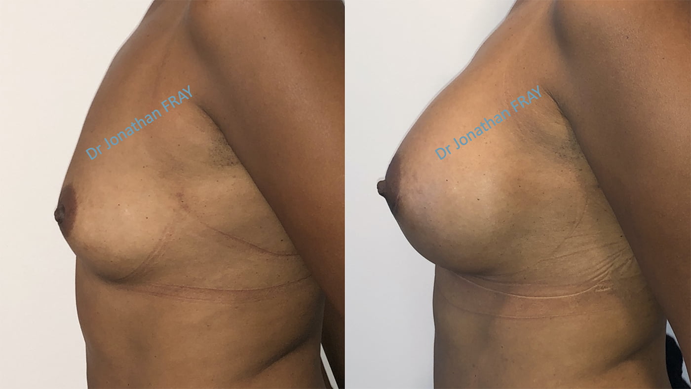 Résultats avant après d'une pose de prothèses de seins à La Réunion