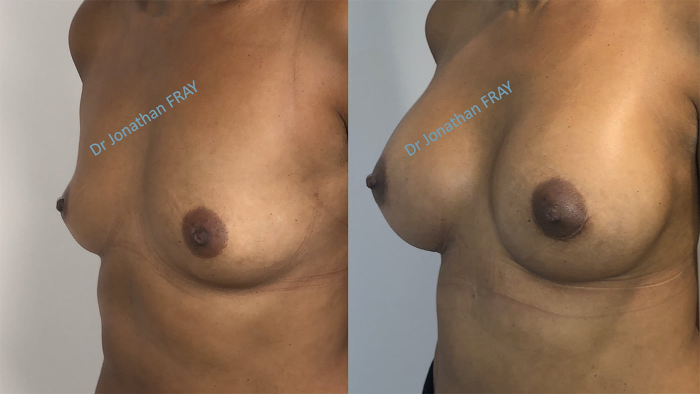 Résultats d'une pose de prothèses de seins à La Réunion