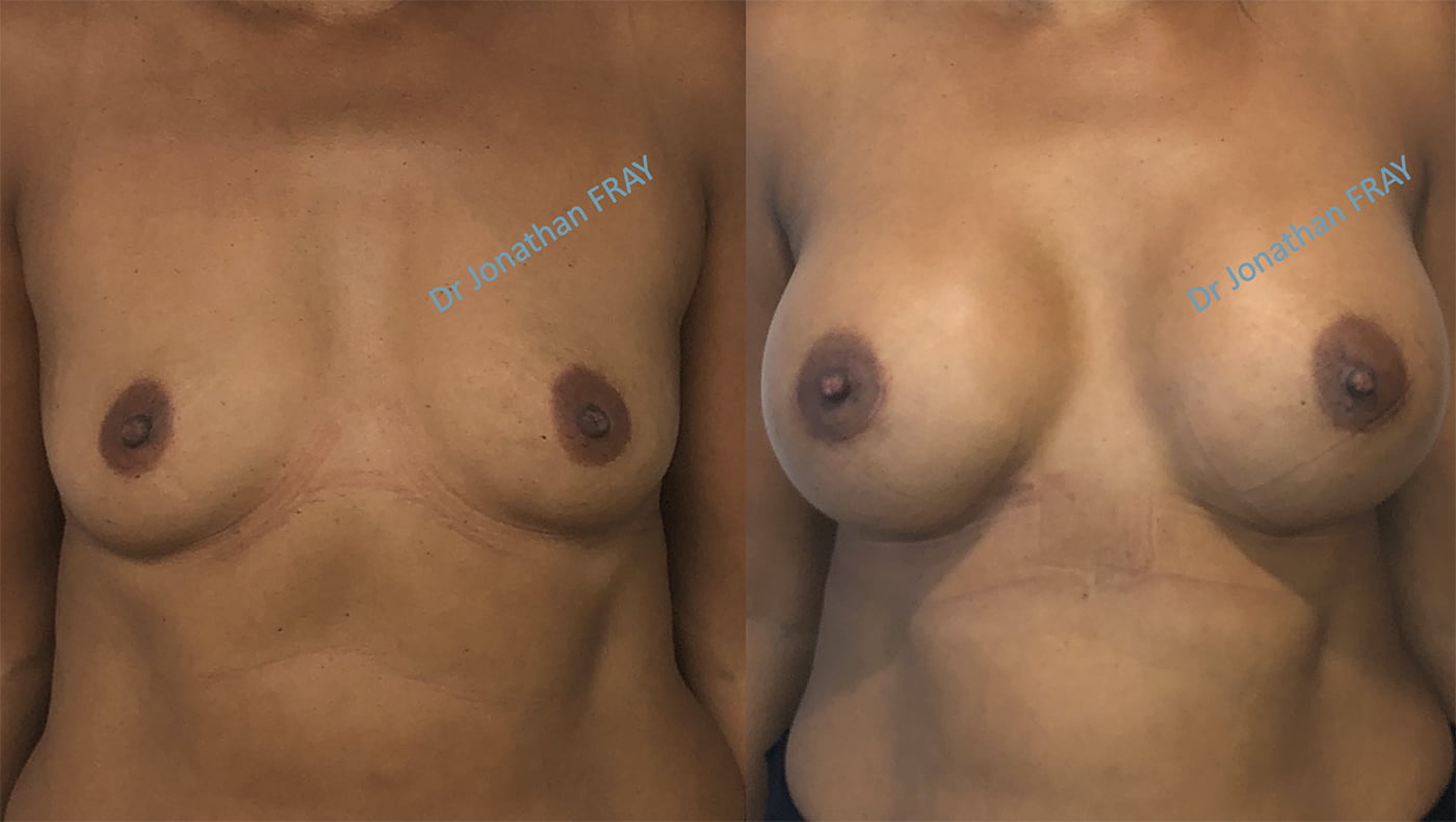Résultats de prothèses de seins à La Réunion