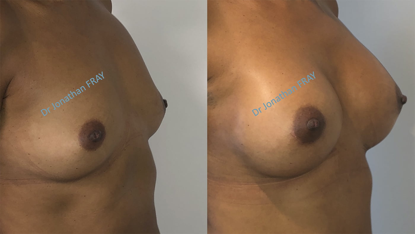 Pose de prothèses de seins à La Réunion : résultats avant après