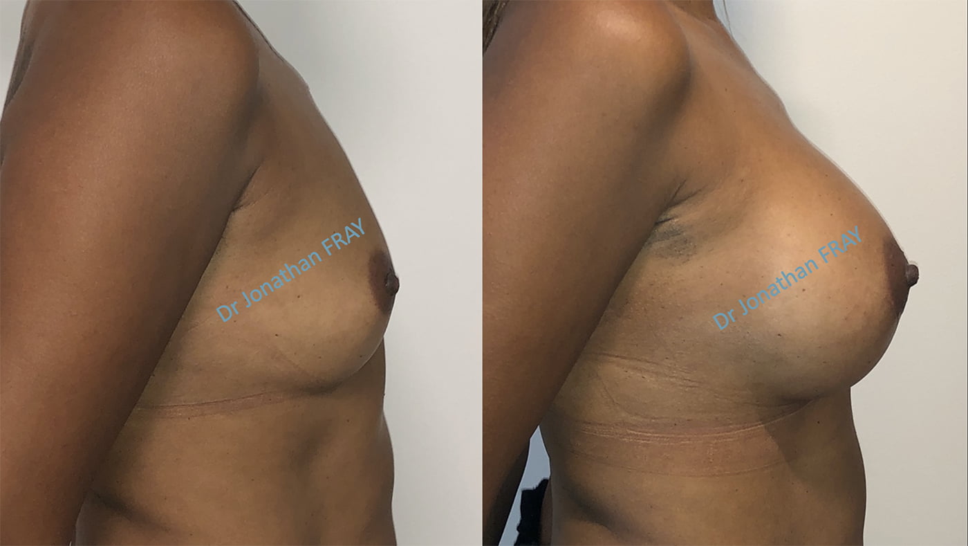 Résultats avant après d'une pose de prothèses de seins