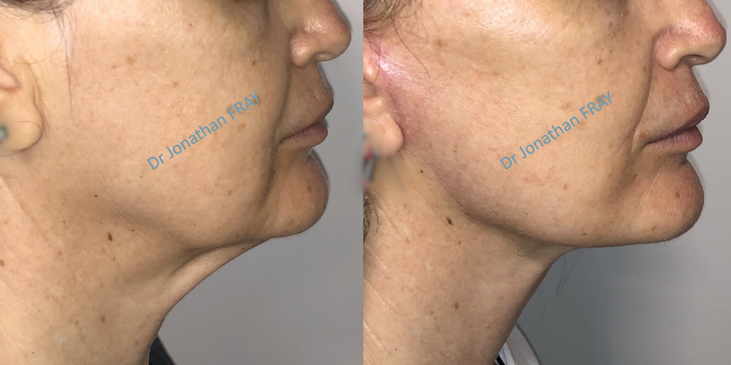 Lifting facial avant après La Réunion
