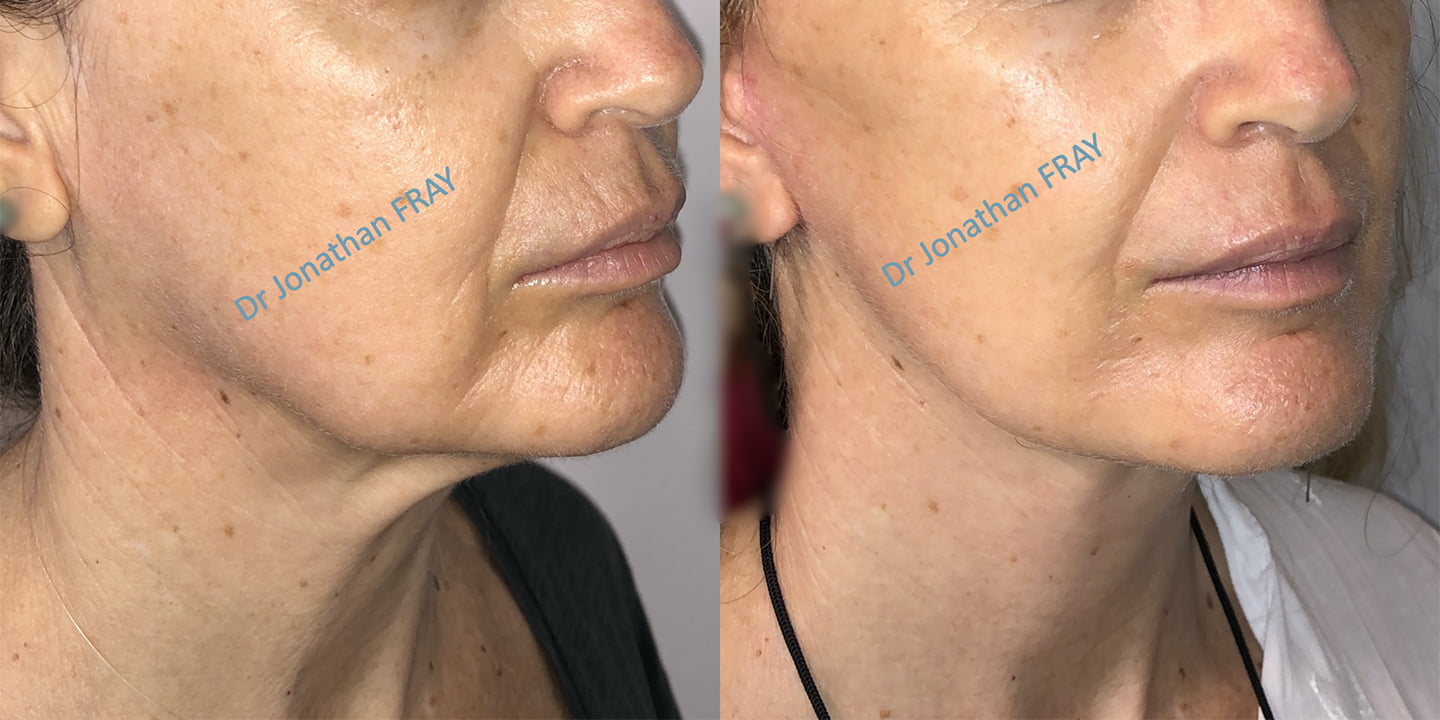 Avant après d'un lifting facial réalisé à La Réunion