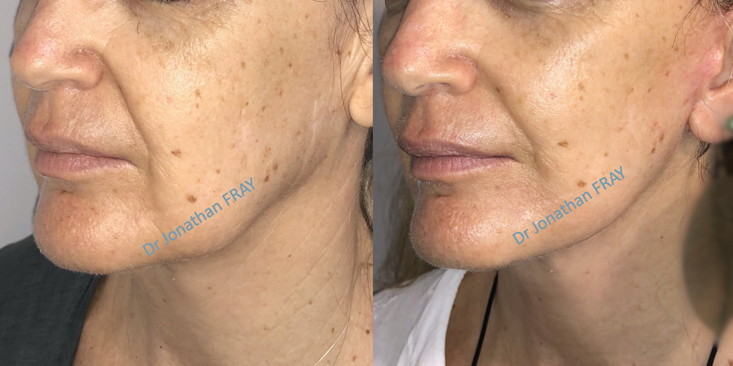 Résultat avant après d'un lifting facial par le Dr Fray