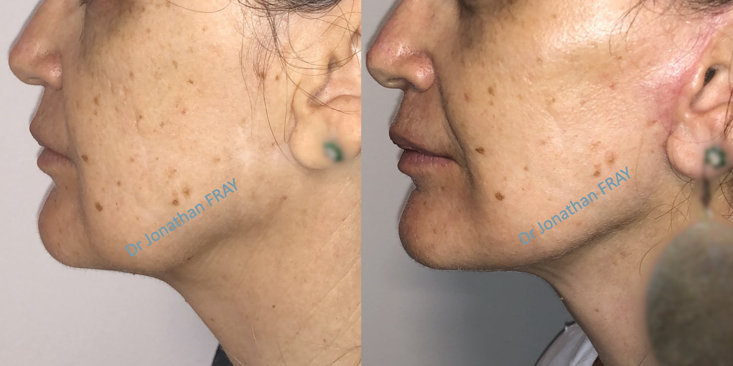 Lifting facial résultats avant après