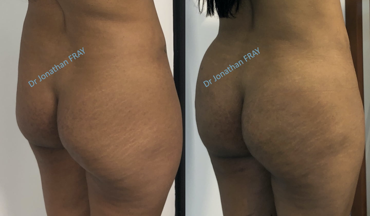 lipostructure-fesses-avant-apres-1 Photos avant après d'une lipostructure des fesses réalisée par le Dr Fray à la Réunion
