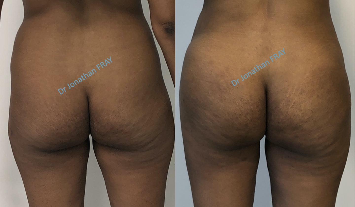 Résultats avant après d'une lipostructure des fesses réalisée par le Docteur Fray