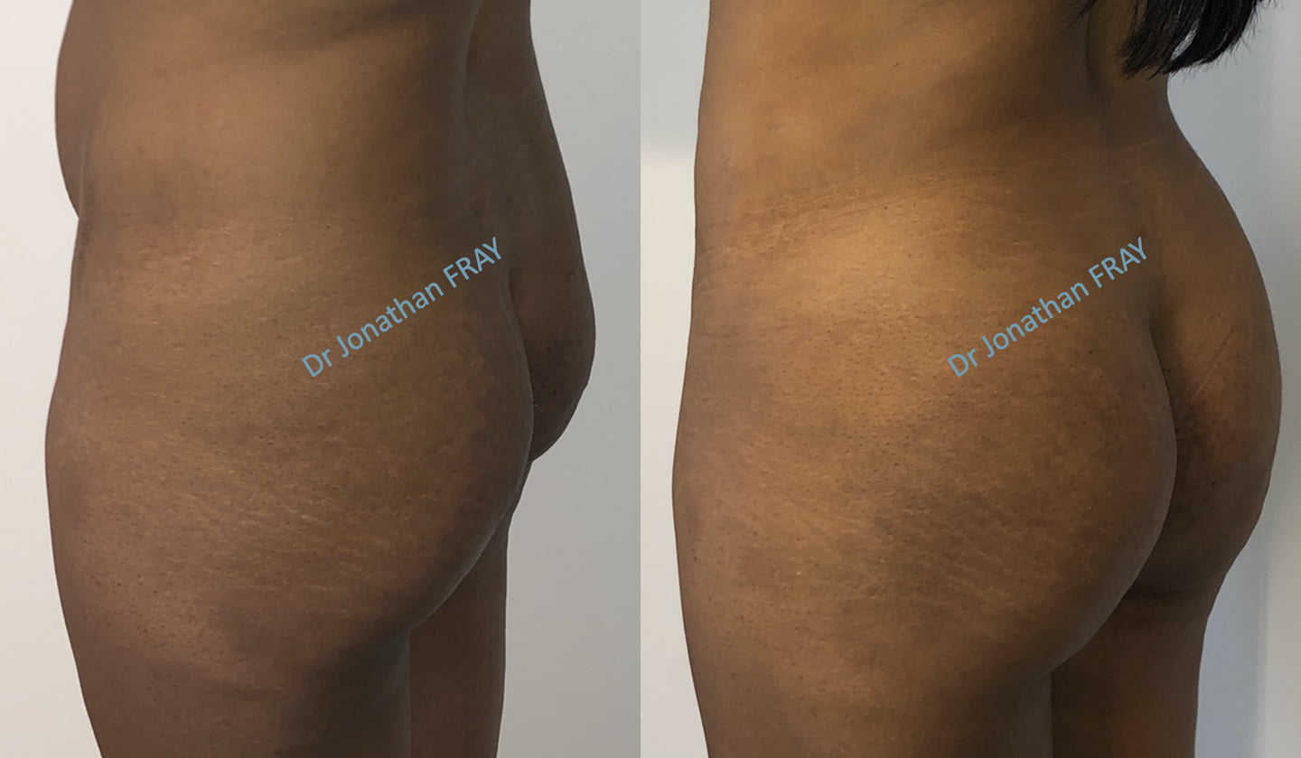Lipostructure des fesses avant après