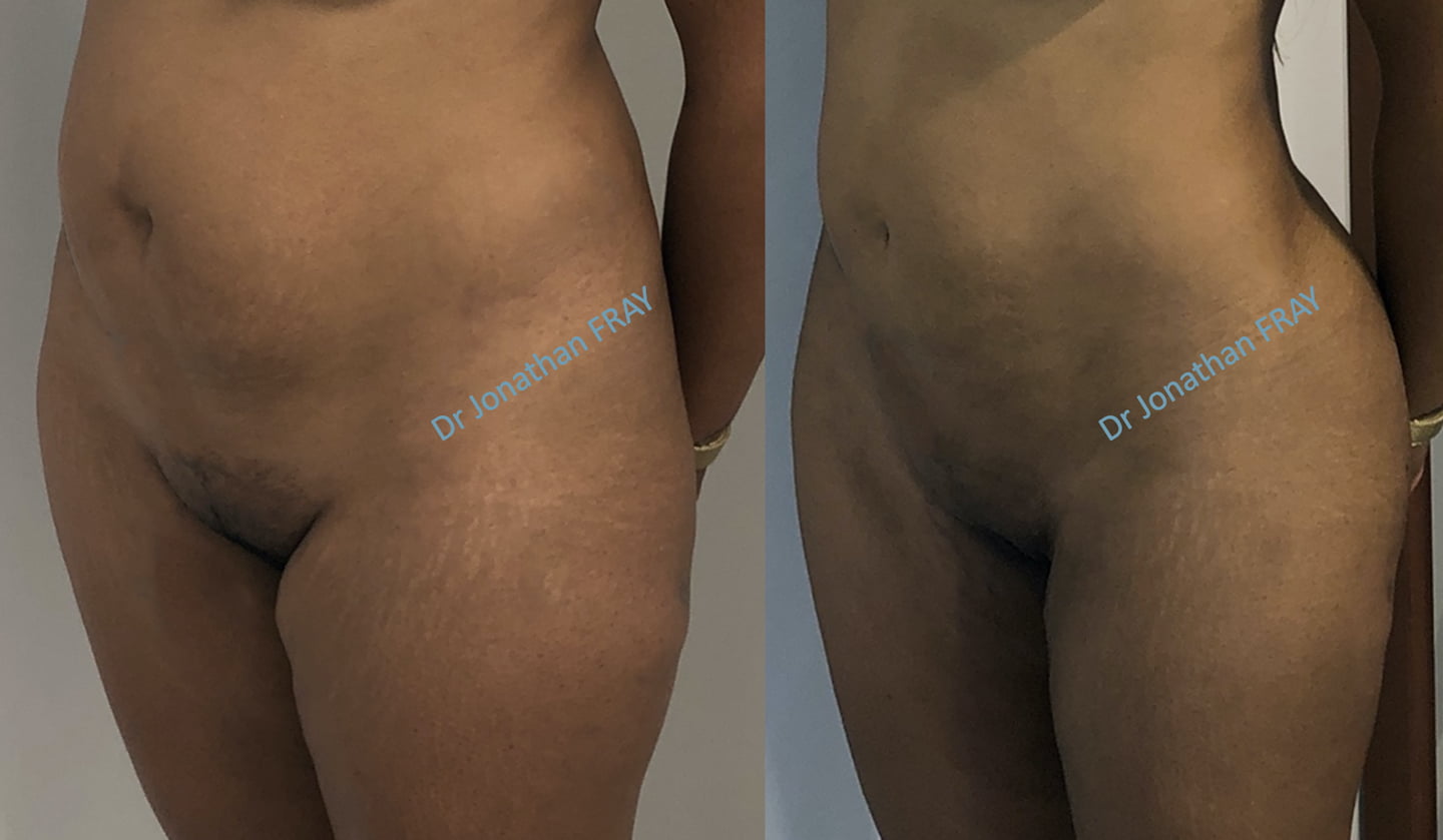 Résultat avant après d'une lipostructure des fesses effectuée à la Réunion