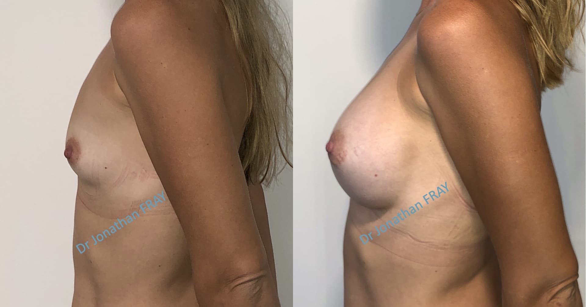 Résultats avant après d'une pose d'implants silicone à la Réunion