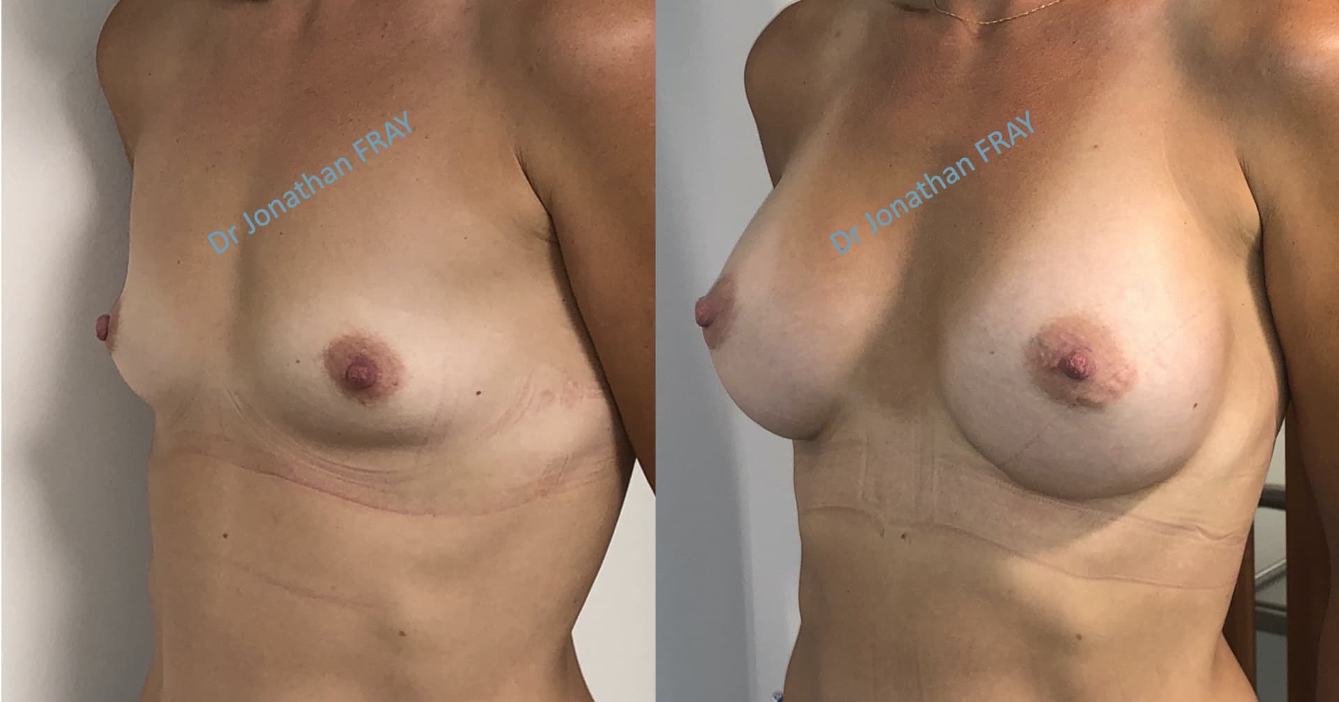 Résultats avant après d'une pose d'implants silicone à la Réunion