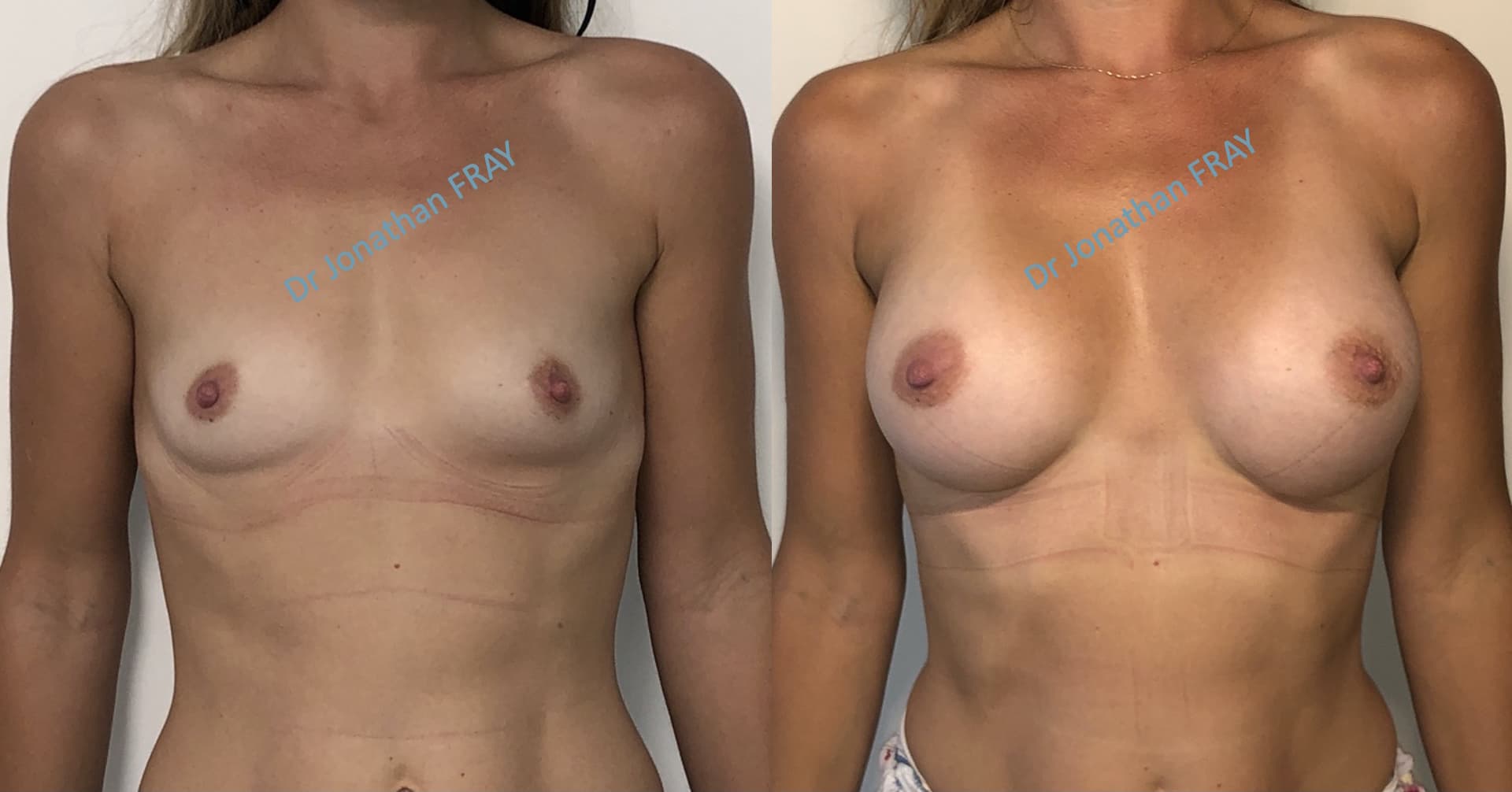 Résultats avant après d'une pose d'implants silicone à la Réunion
