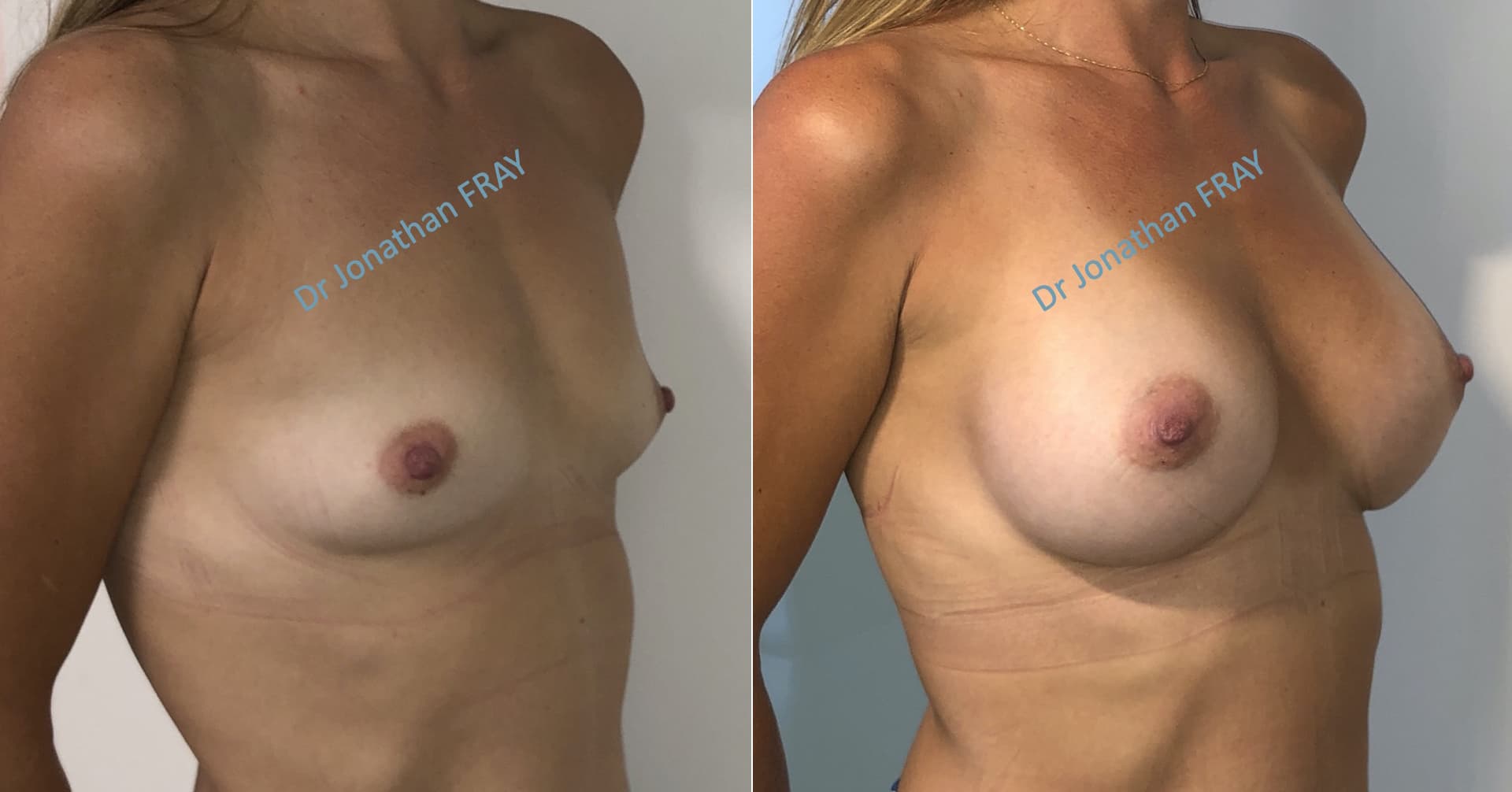 Résultats avant après d'une pose d'implants silicone à la Réunion