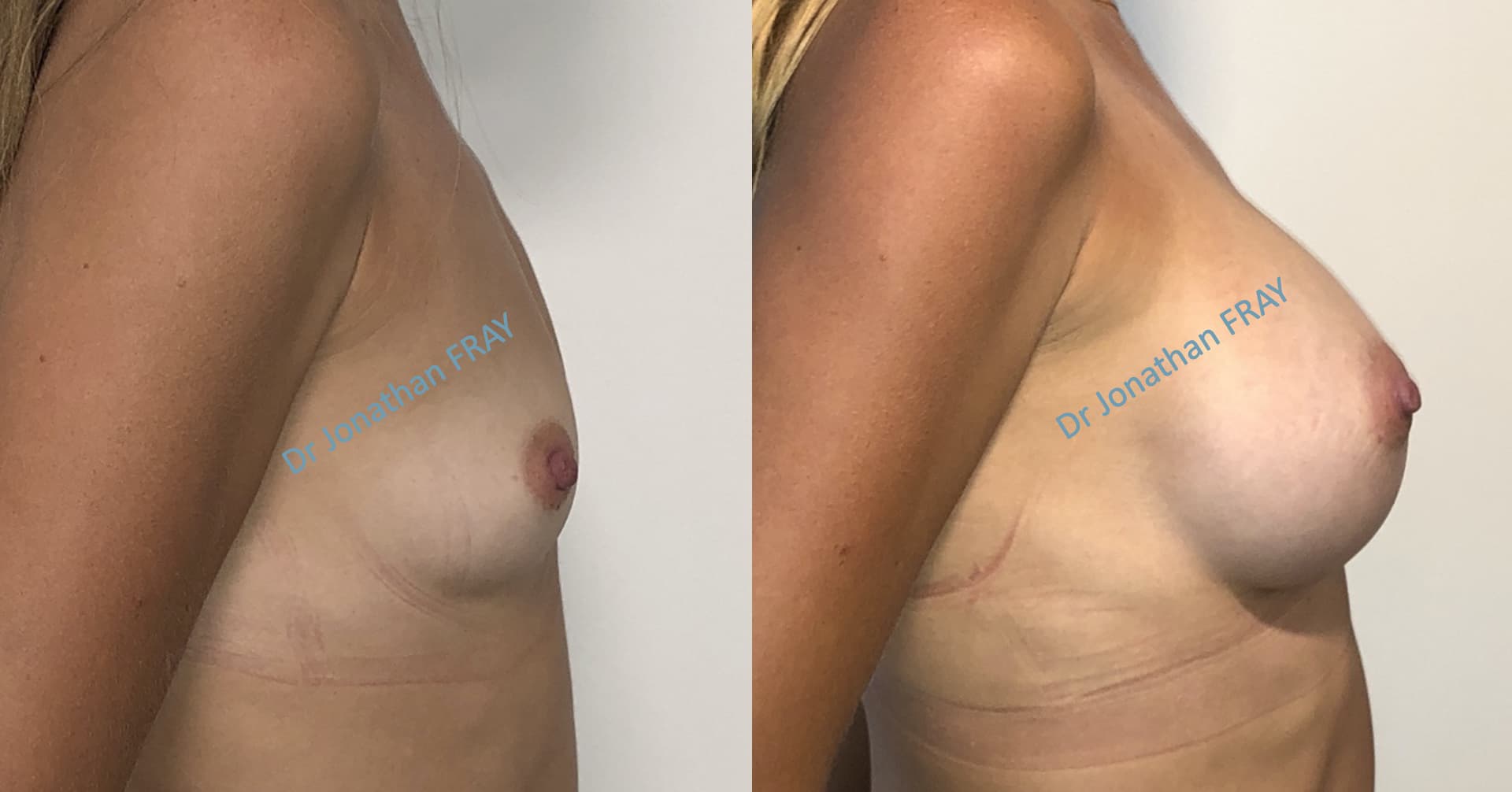 Résultats avant après d'une pose d'implants silicone à la Réunion
