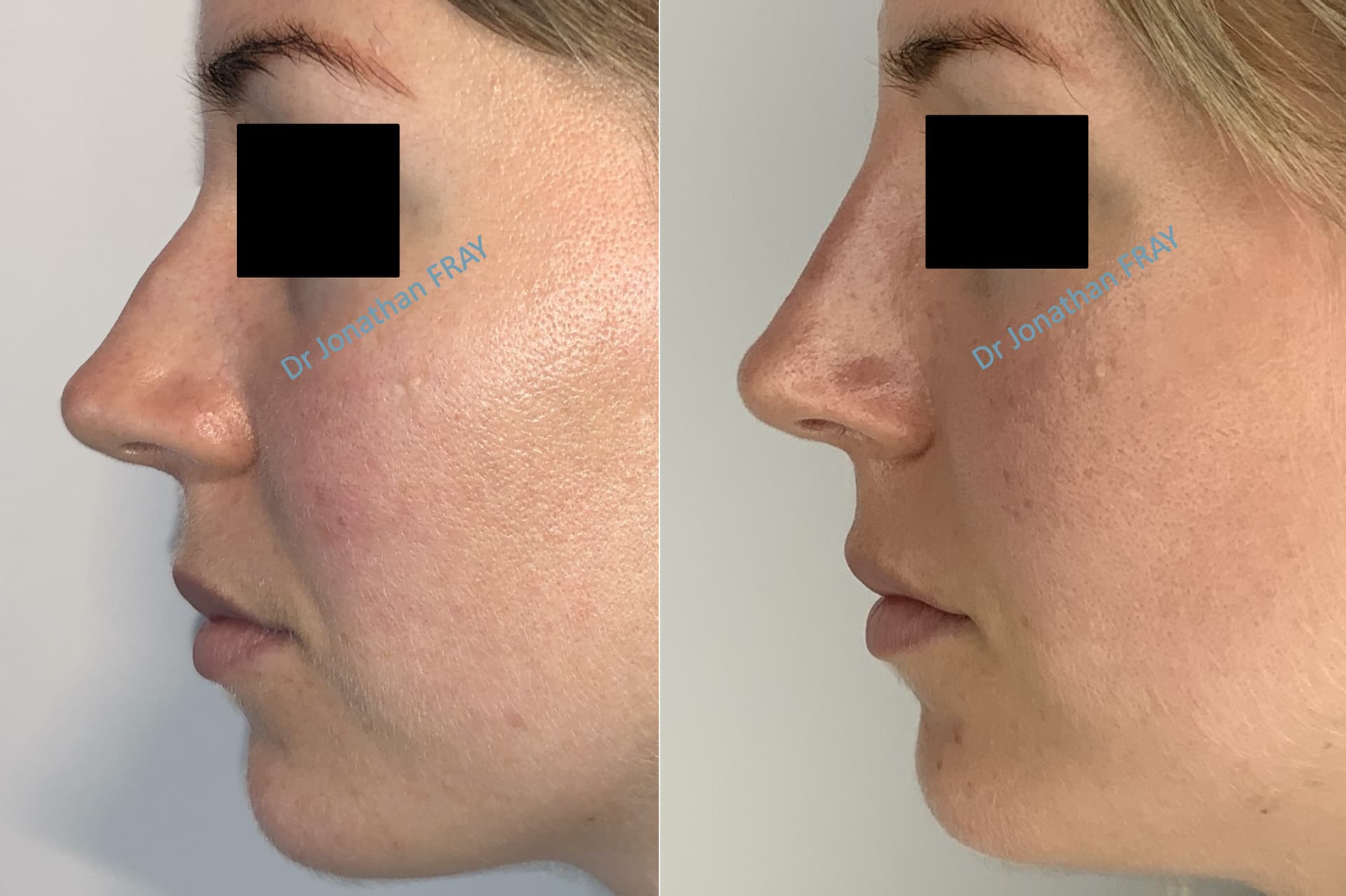 Résultats avant après d'une rhinoplastie médicale par injection d'acide hyaluronique
