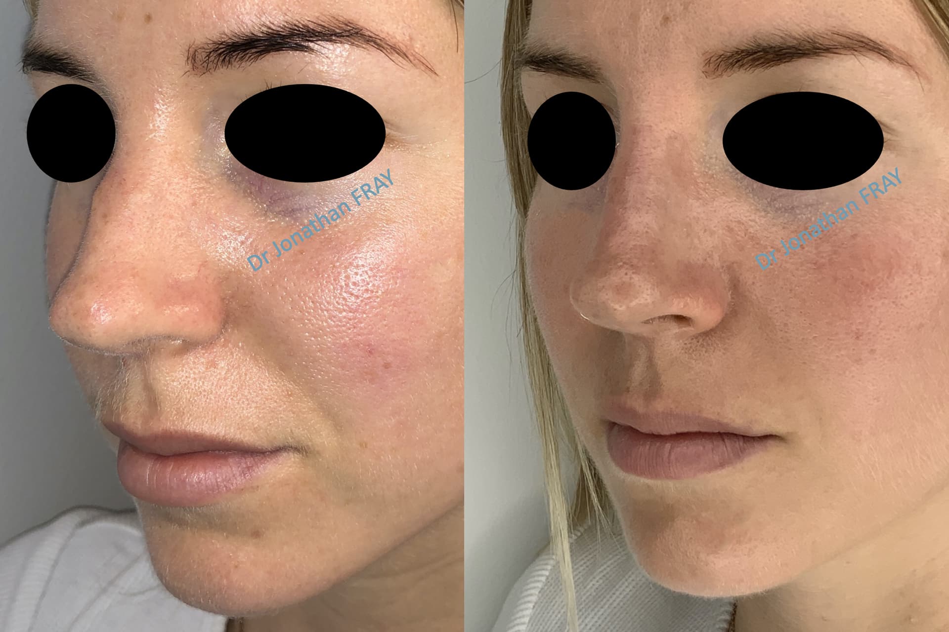 Résultats avant après d'une rhinoplastie médicale