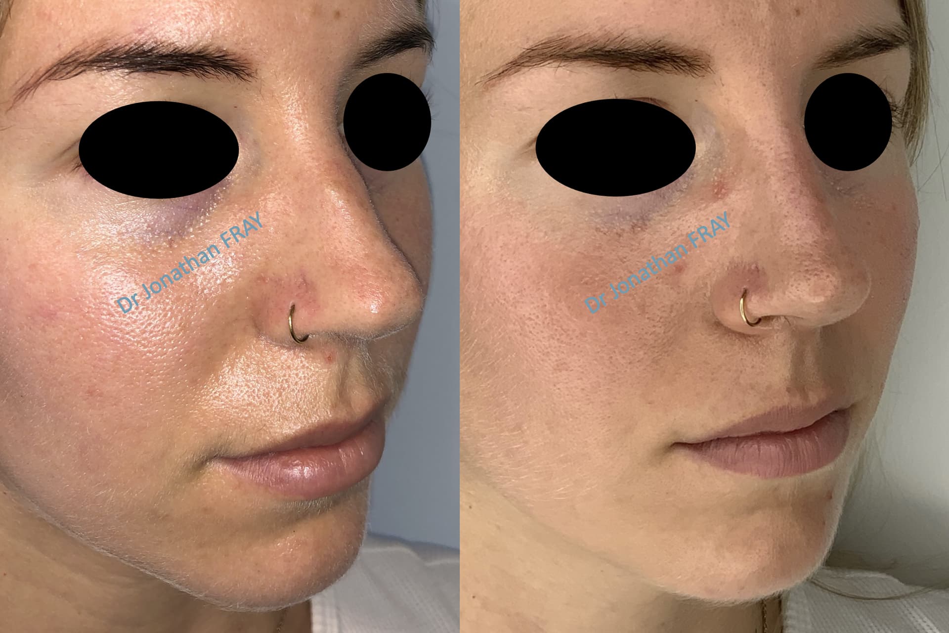 Avant après de rhinoplastie médicale