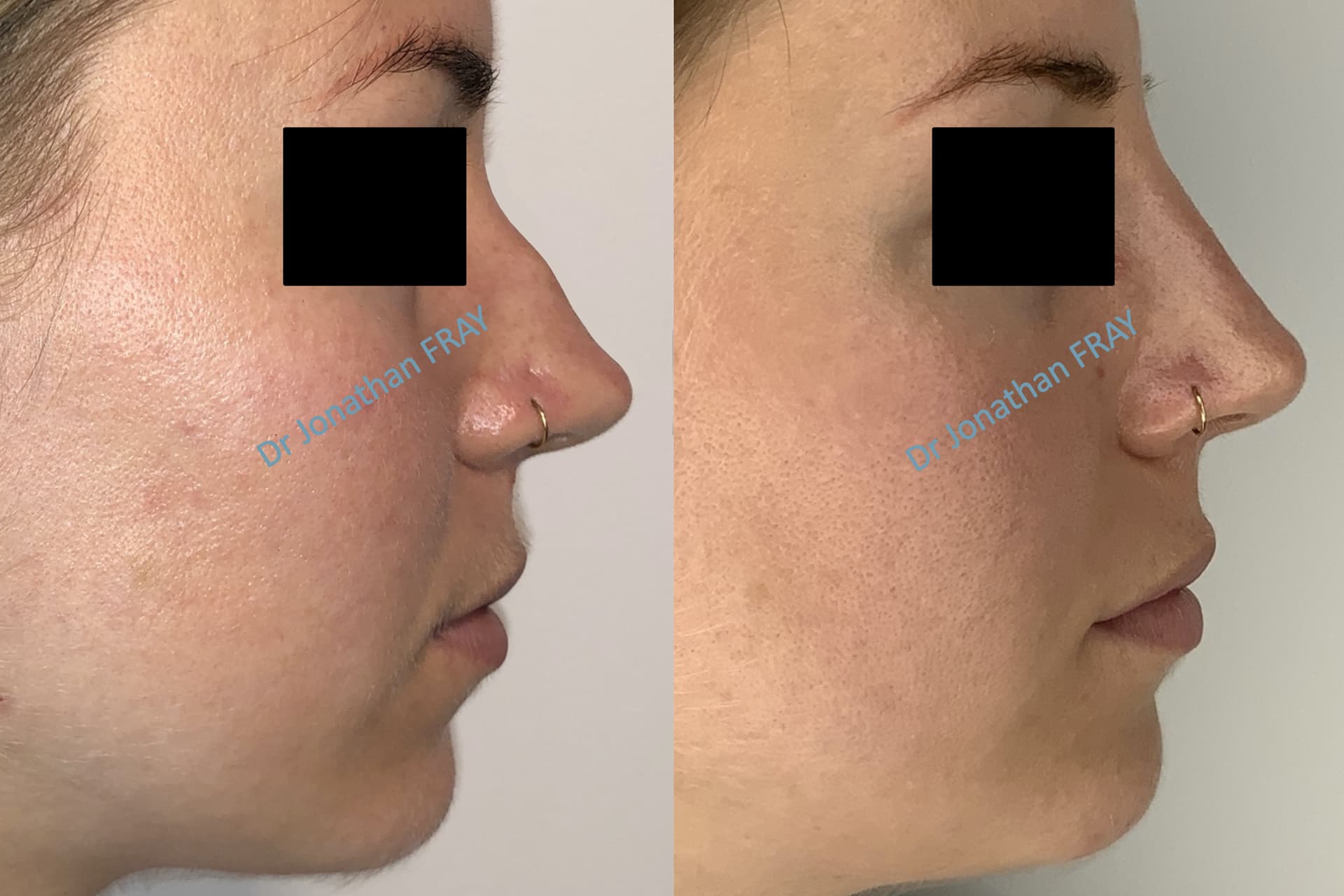 Rhinoplastie médicale avant après