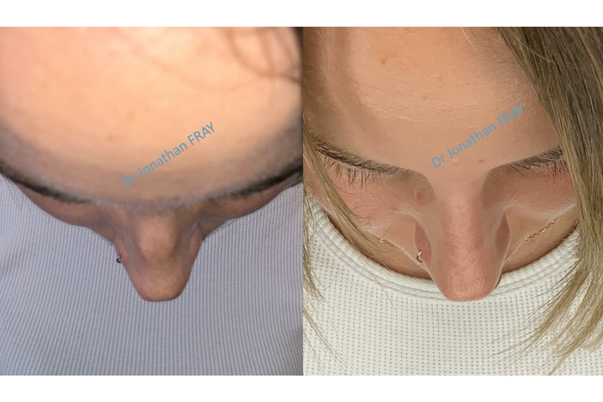 Rhinoplastie médicale photos avant après