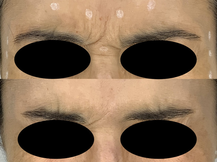Résultats avant après d'injection de botox dans le front