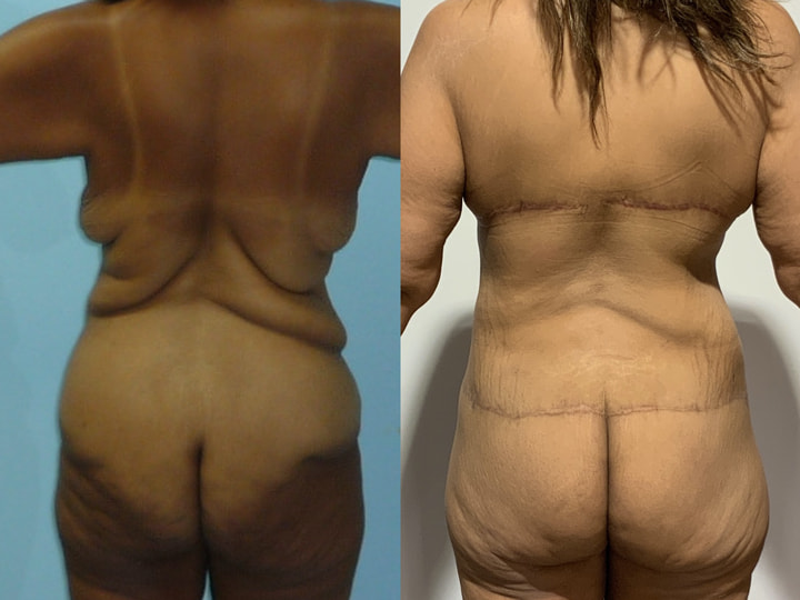 Patiente de dos présentant ses résultats après un bodylift réalisé par le Dr Fray à La Réunion