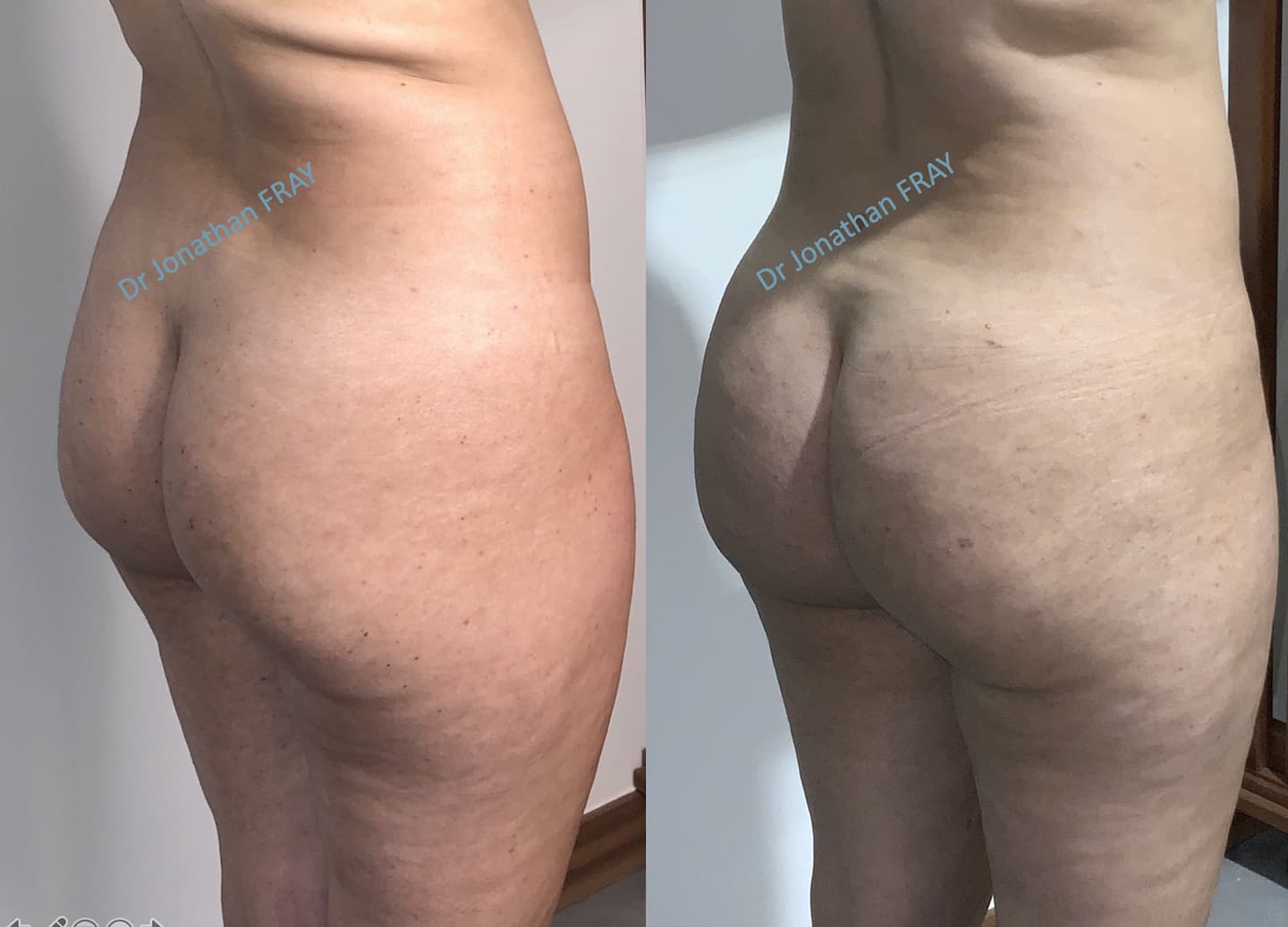 lipostructure-fessier-avant-apres-3