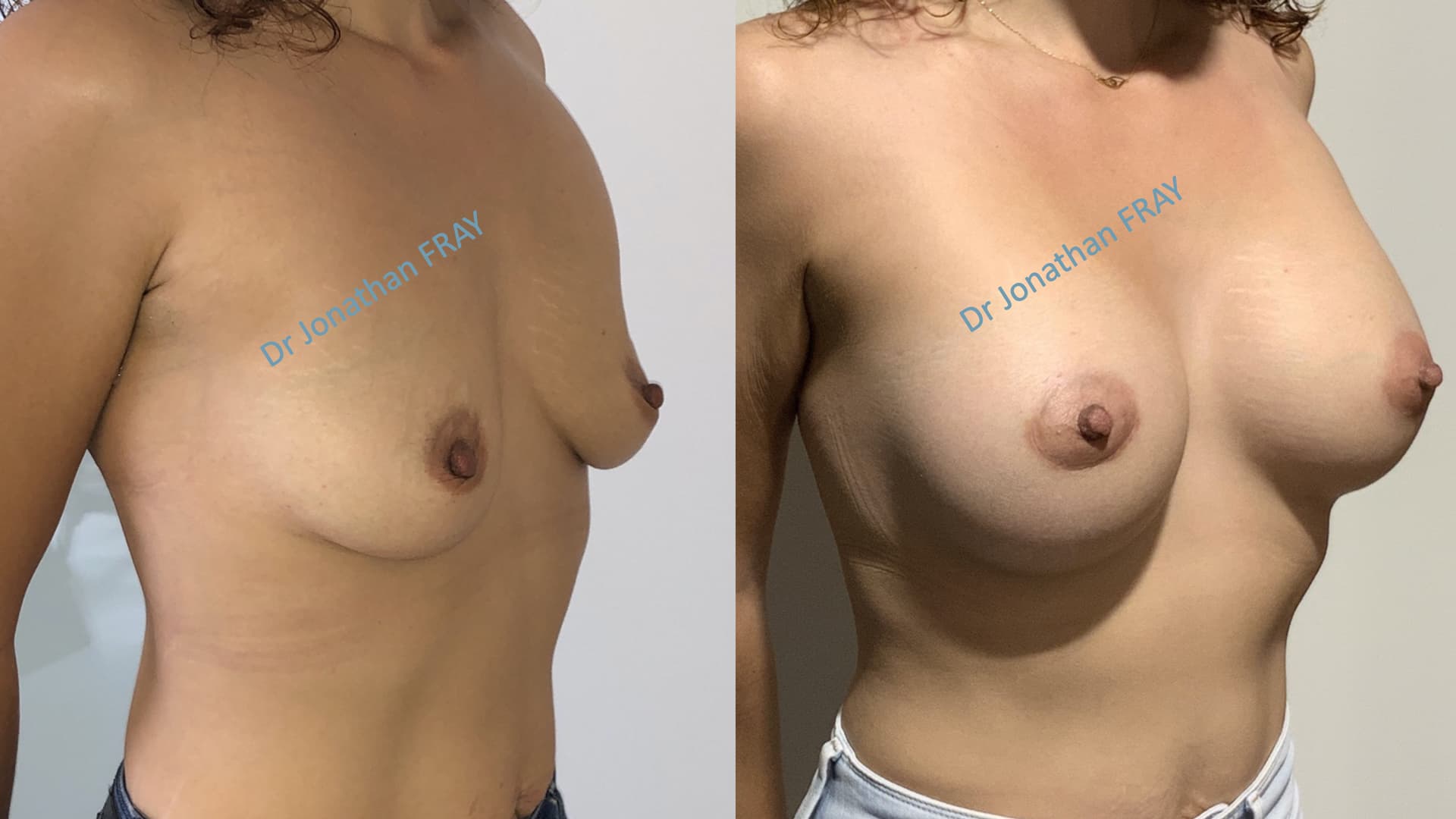 Exemple de résultat de profil obtenus après une augmentation mammaire par prothèse par le Dr Fray à La Réunion