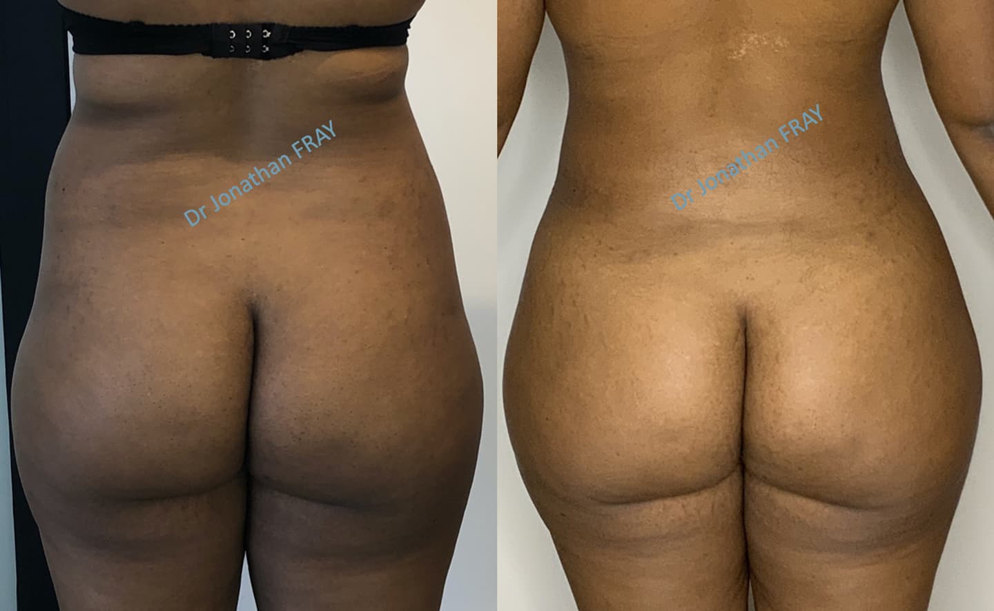 Résultat avant après d'une lipostructure des fesses - vue de dos