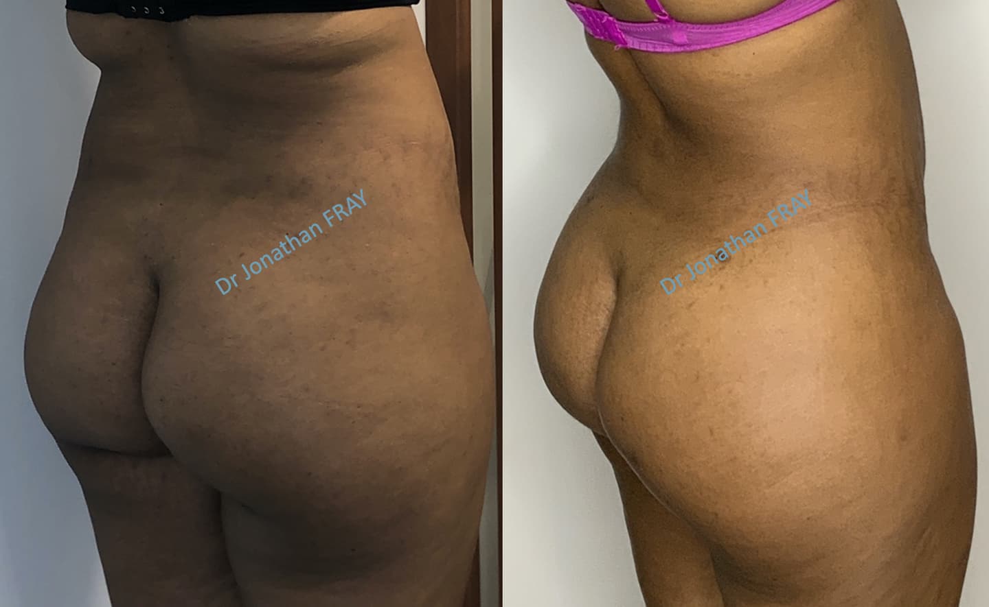lipostructure-des-fesses-avant-apres-2 Résultat avant après d'une lipostructure des fesses - vue transversale