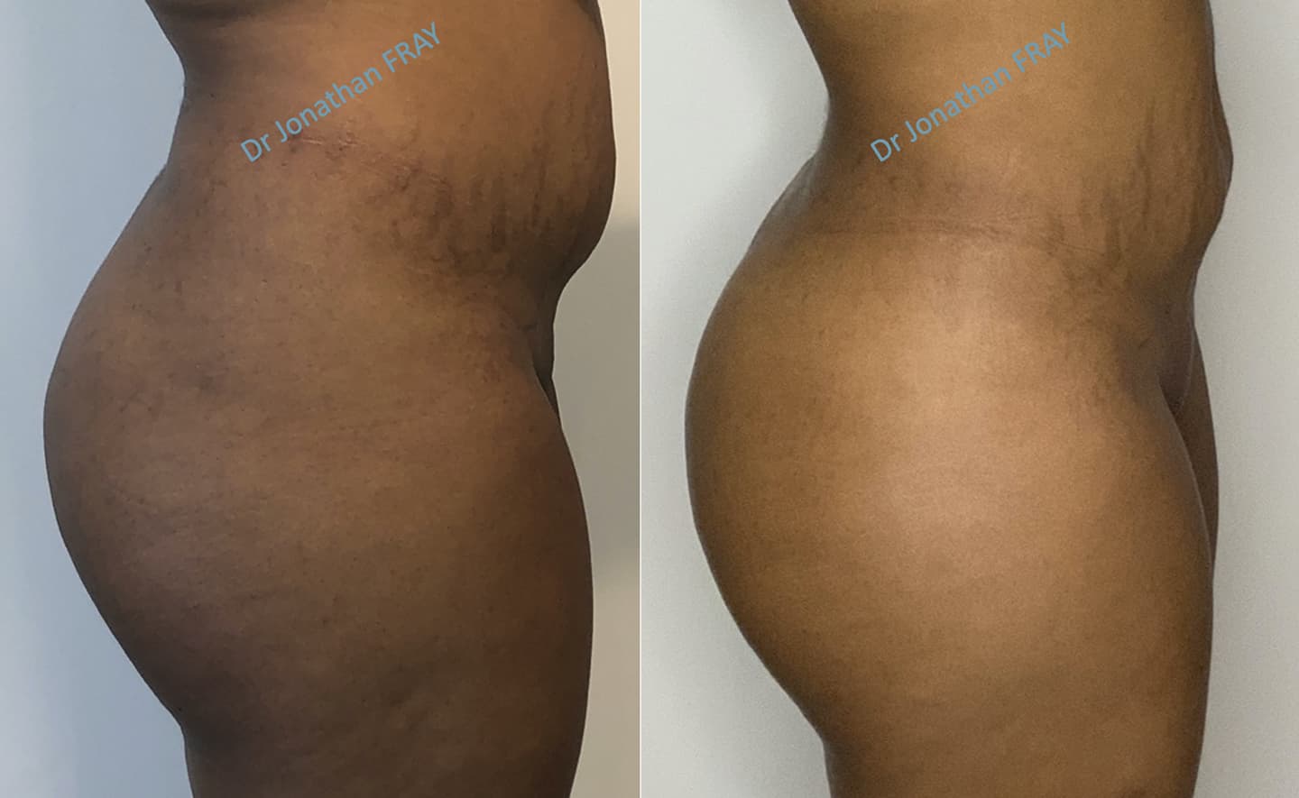 Résultat avant après d'une lipostructure des fesses - vue de côté