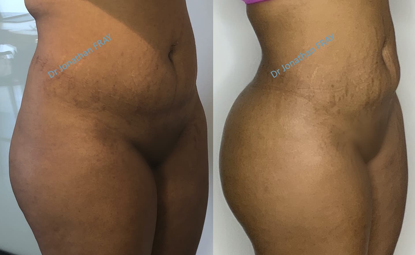 Résultat avant après d'une lipostructure des fesses - vue de 3/4