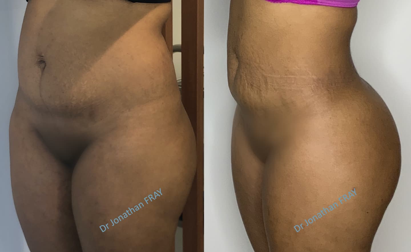 Résultat avant après d'une lipostructure des fesses - vue de profil