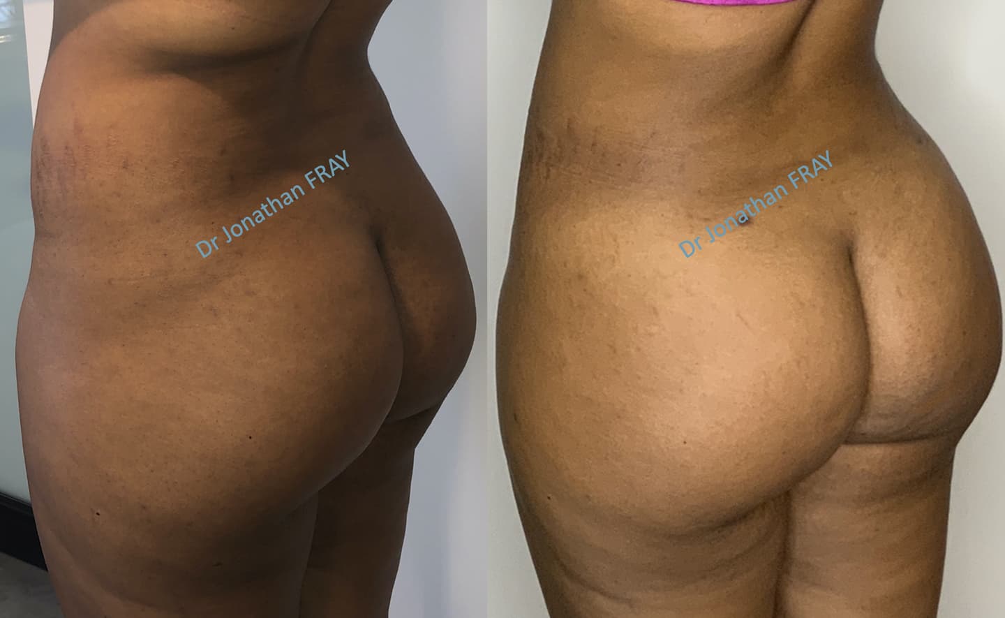 Résultat avant après d'une lipostructure des fesses - vue de dos