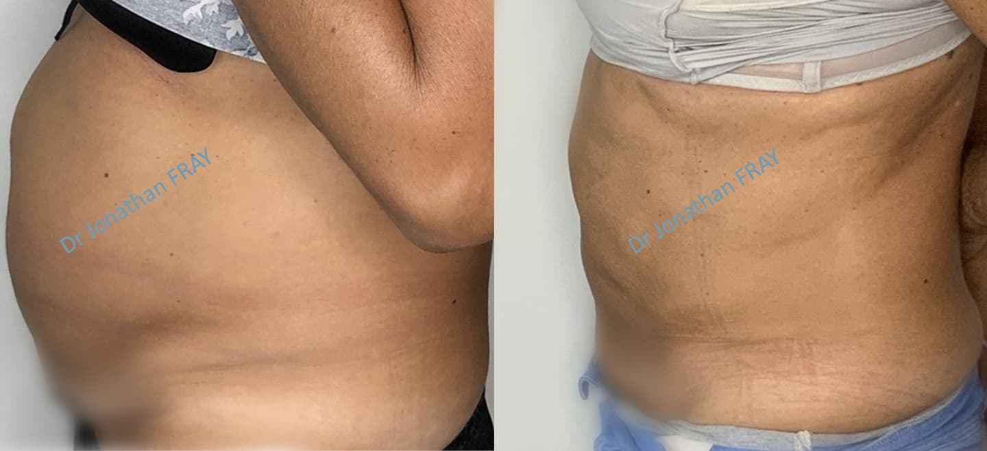 liposuccion-abdominale-resultats-avant-apres-1 Résultats avant après d'une liposuccion abdominale réalisée par le Dr Fray à La Réunion - vue de profil