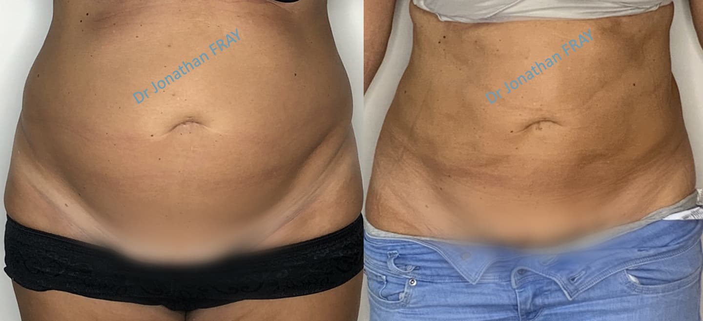 liposuccion-abdominale-resultats-avant-apres-2 Résultats avant après d'une liposuccion abdominale réalisée par le Dr Fray à La Réunion - vue de face