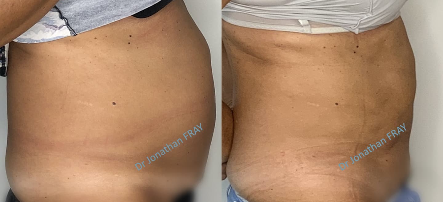 liposuccion-abdominale-resultats-avant-apres-3 Résultats avant après d'une liposuccion abdominale réalisée par le Dr Fray à La Réunion - vue de côté
