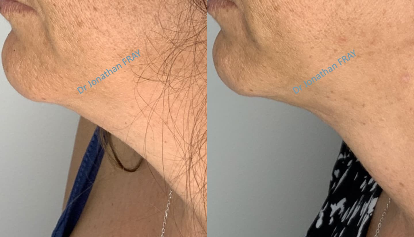 Résultats avant après de liposuccion du double menton