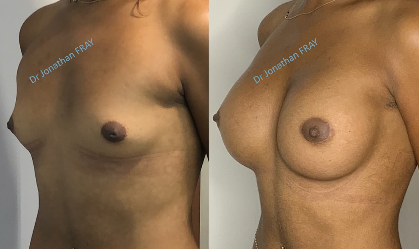 Résultats avant après d'une pose de prothèse de seins par le docteur Fray à La Réunion