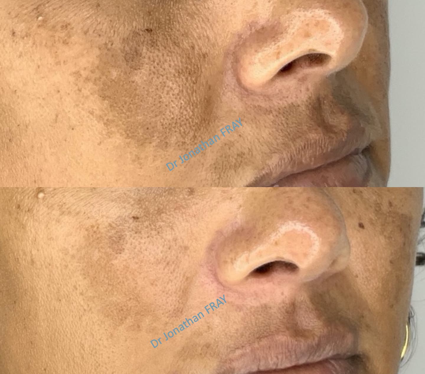 peeling-tache-visage-avant-apres