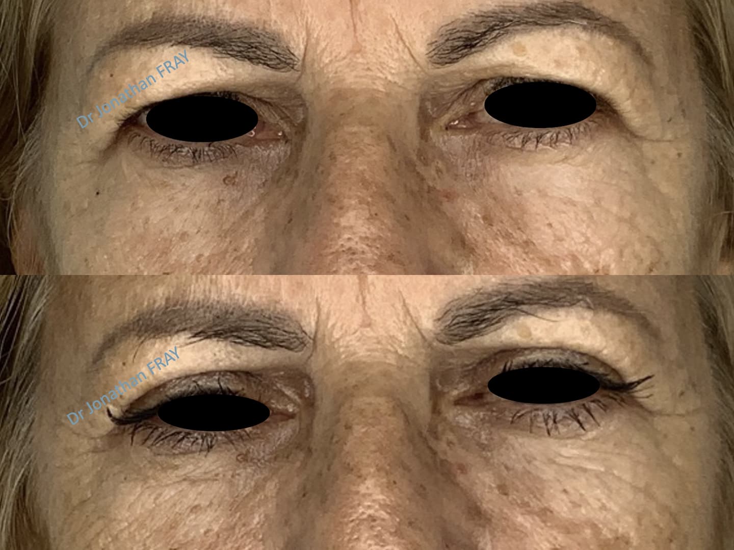 blepharoplastie superieur photos avant apres