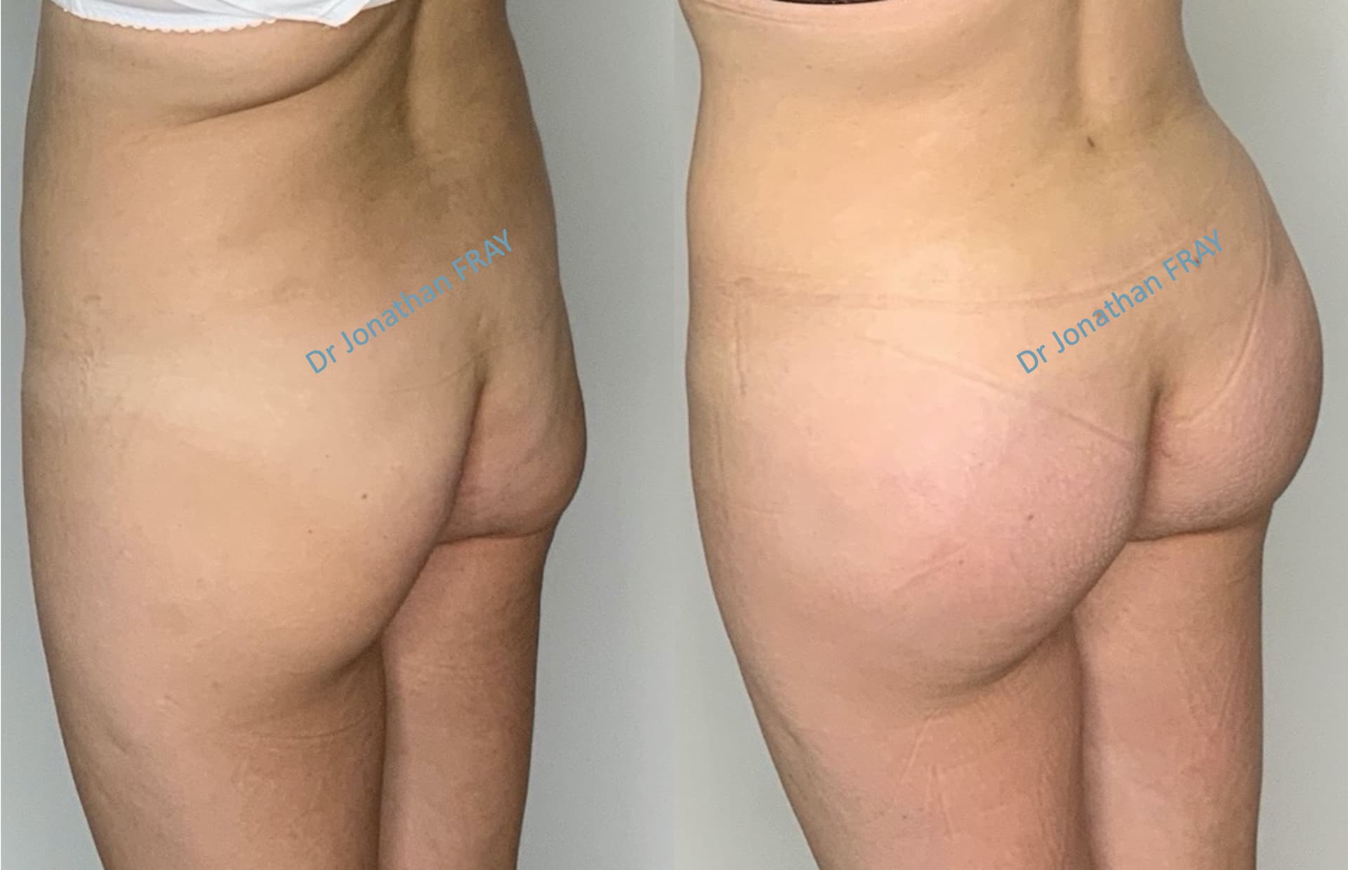 protheses-fesses-3-avant-apres-2