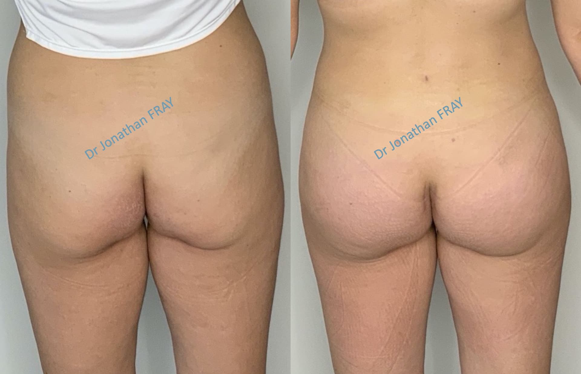 protheses-fesses-3-avant-apres-3