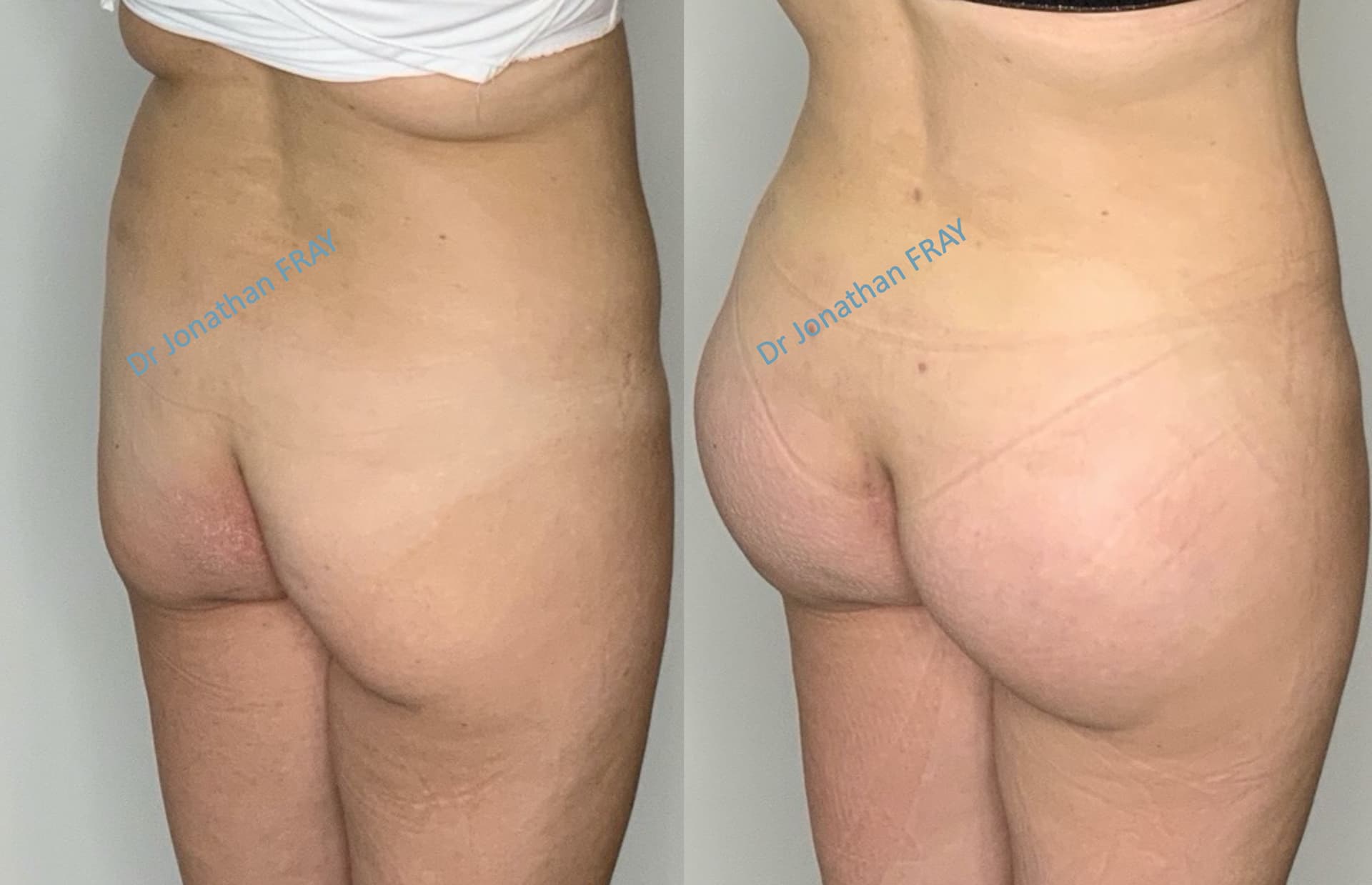 protheses-fesses-3-avant-apres-4