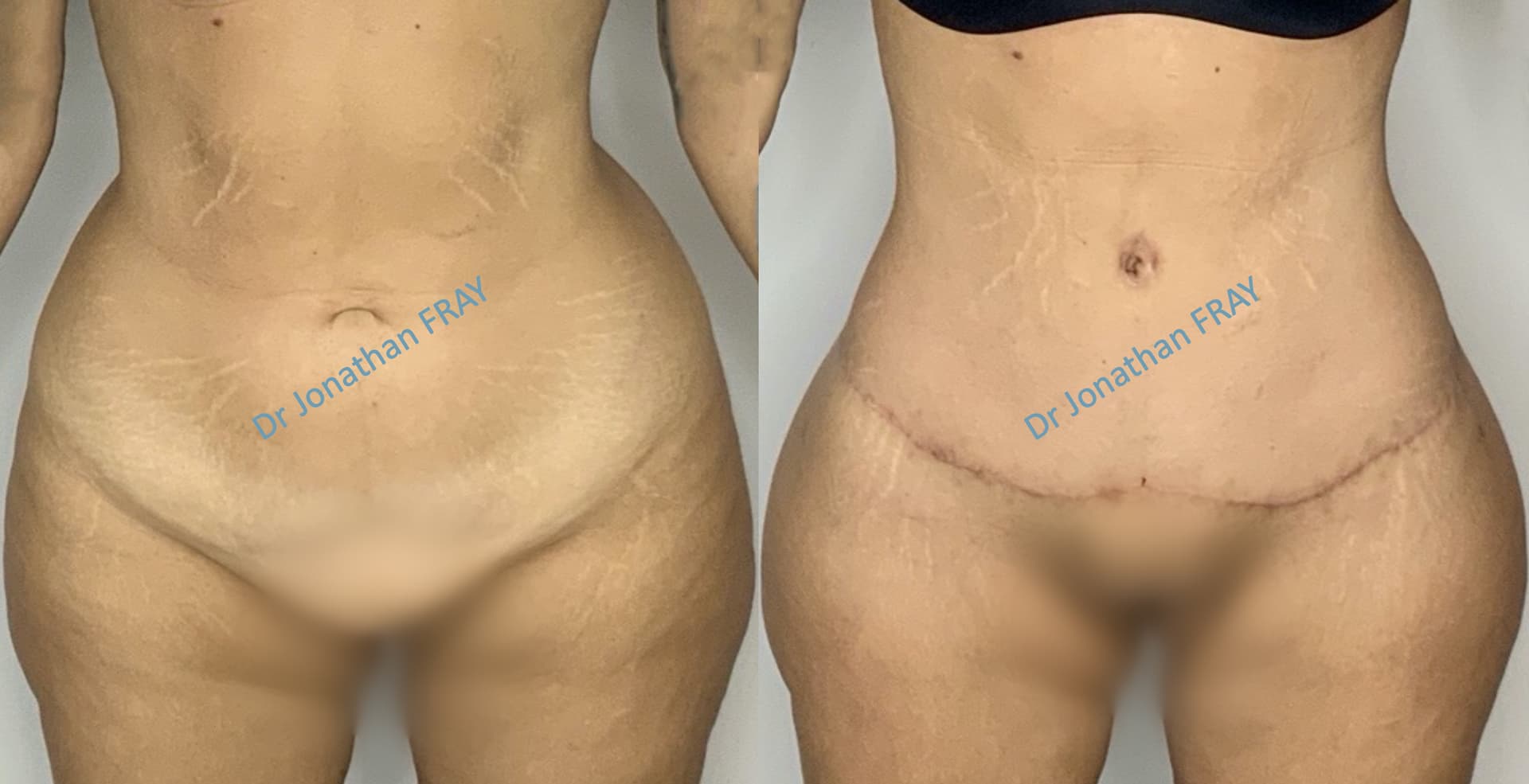 bodylift-4-avant-apres-1