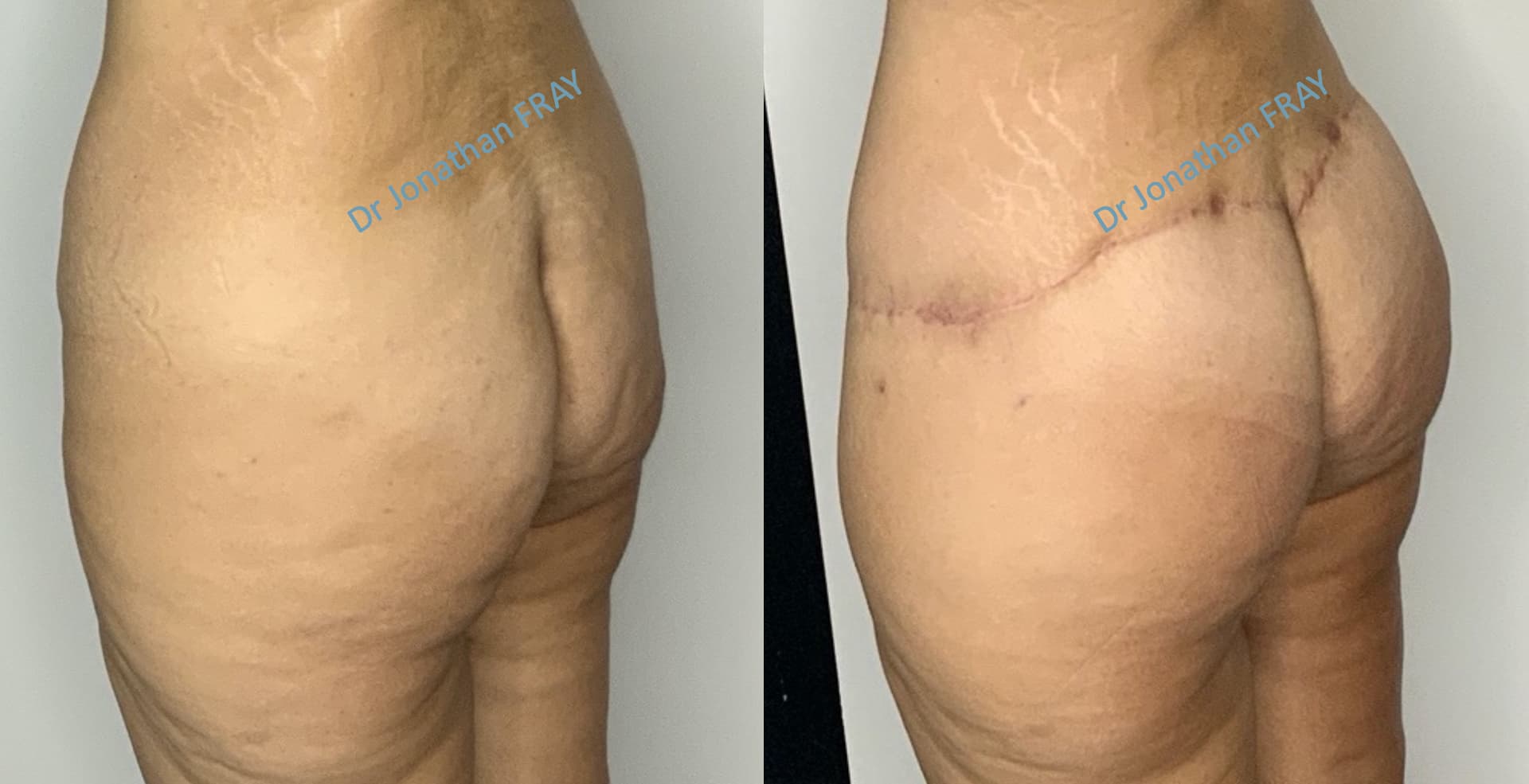 bodylift-4-avant-apres-2